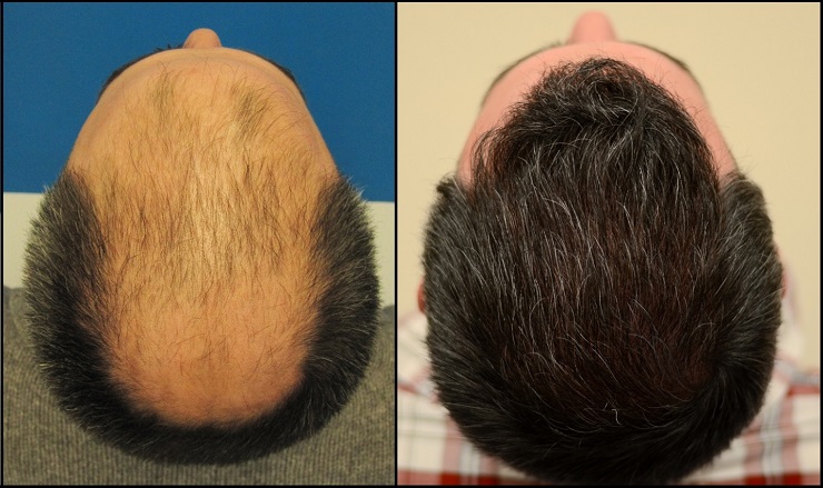 Trasplante de cabello natural - Although there is no clear cure for this condition, there are ways in which we can stop it and even reverse it, one of them is the natural hair transplant.